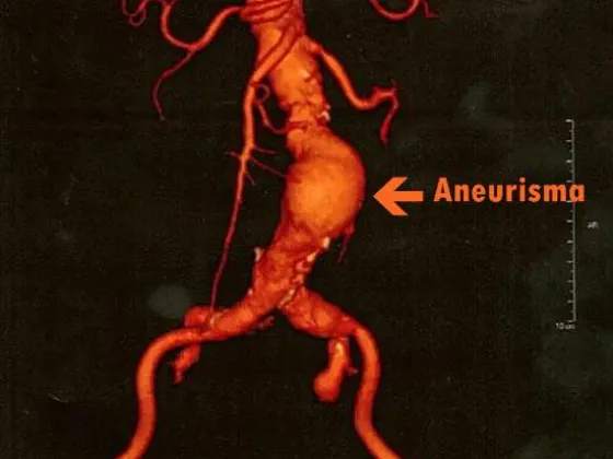 Angiotomografía de aorta