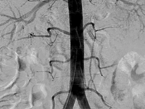 Angiografía digital de aorta