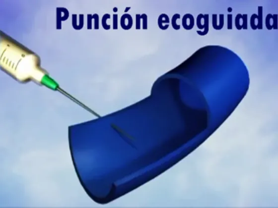 Punción eco - guiada