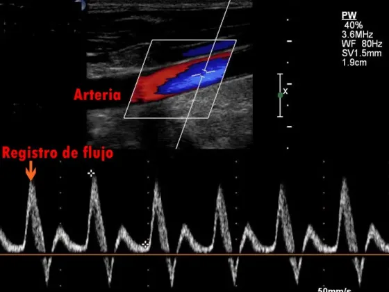 Ecodoppler color arterial