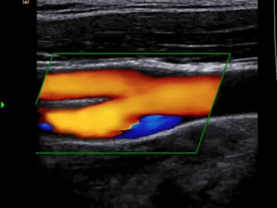 Ecodoppler color arteria carótida