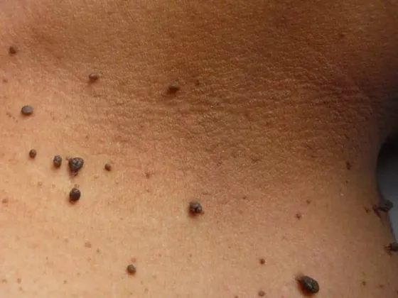 Fibromas en cuello para tratamiento qurúrgico