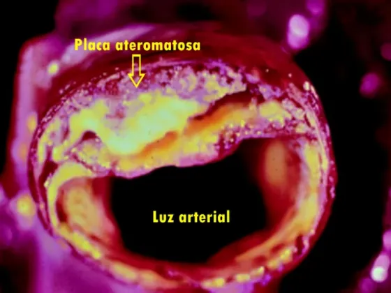 Arteriopatía