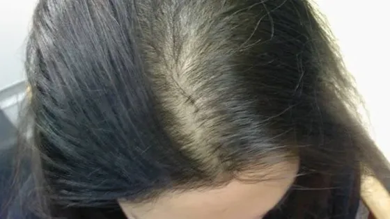 Alopecia en la mujer