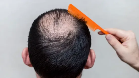 Alopecia masculina